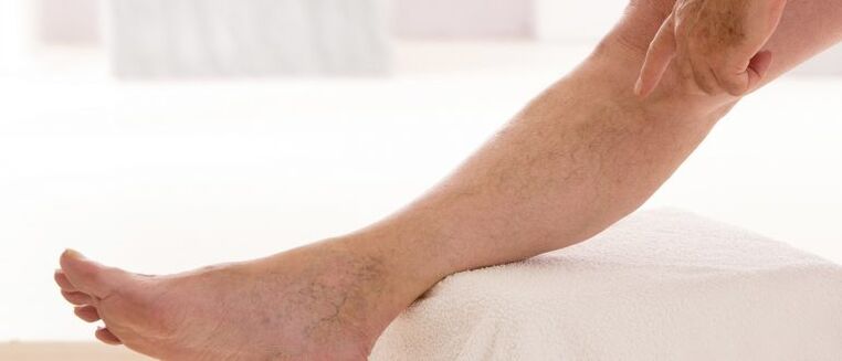 Κιρσοί φλέβες στα πόδια